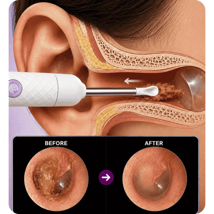 Smart Ear Cleaner with Camera